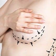 BREAST-augmentation-naperville,-illinois-home
