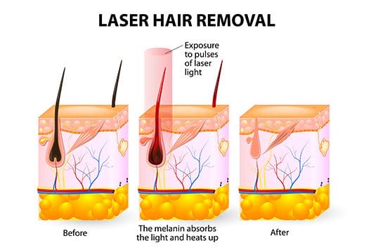 laser hair removal geneva, il